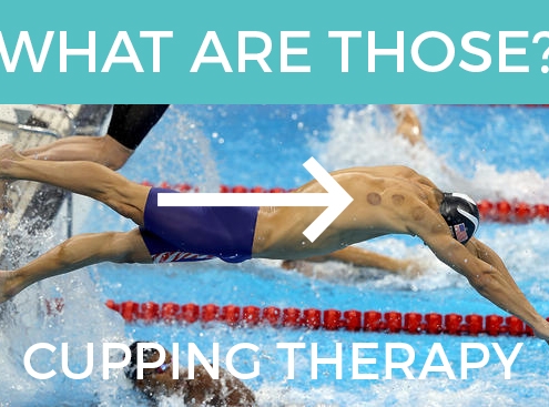 What is cupping therapy?