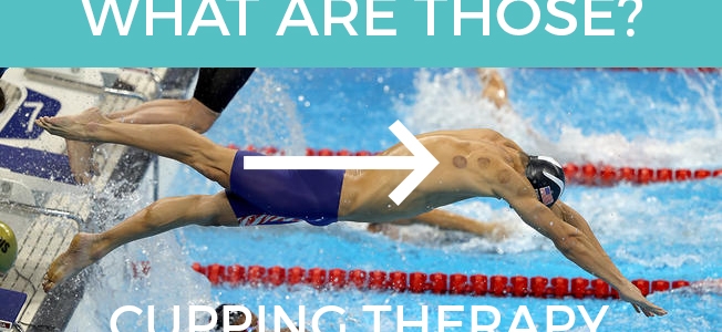 What is cupping therapy?