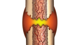 Stress Fracture Rehab – A Bone Stimulator + Cross Training — Run